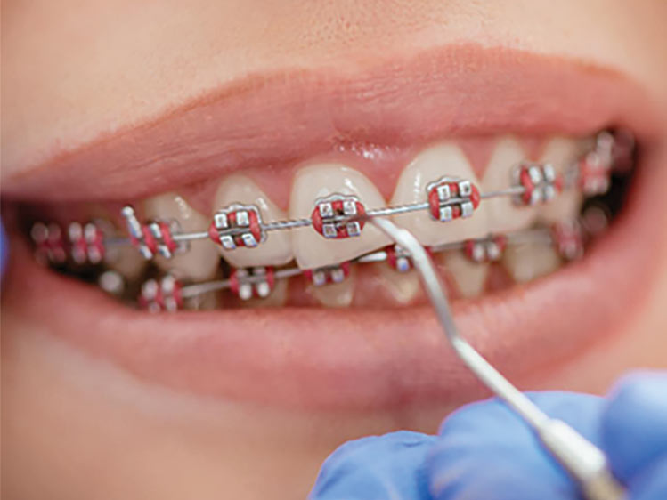Aparelho Fixo com Braquetes