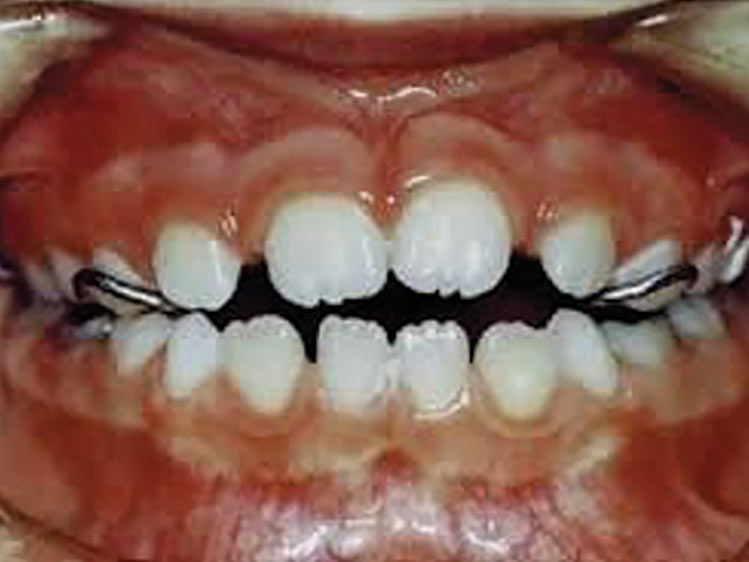 Aparelho Fixo Disjuntor 1