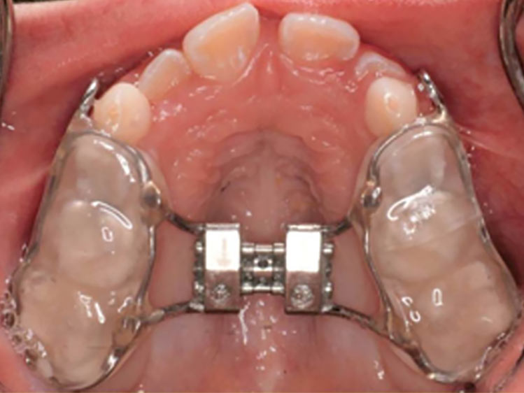 Aparelho Fixo Disjuntor