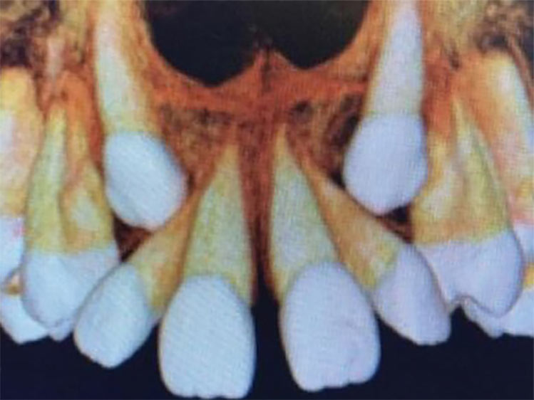 Guiando a erupção dos caninos superiores