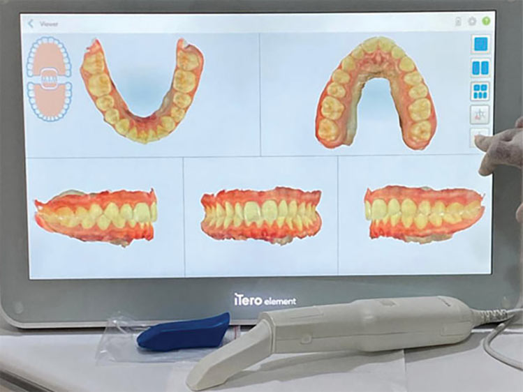 Escaneamento Intra-oral