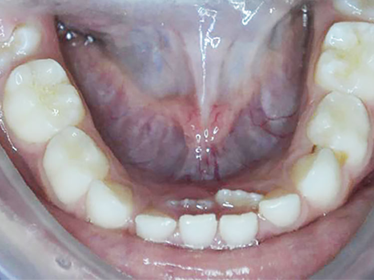 Falta de Espaço para os dentes inferiores