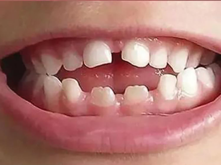 Mordida Aberta pelo Uso da Chupeta