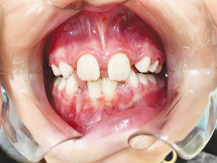 Mordida Cruzada Corrigida