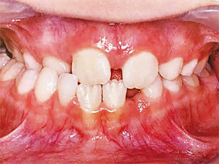 Mordida Cruzada Lado Direito