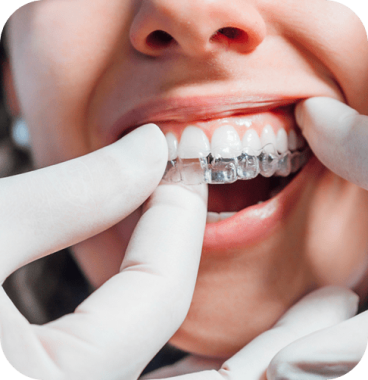 Aparelho invisível Invisalign - Clínica Odontológica Brandes